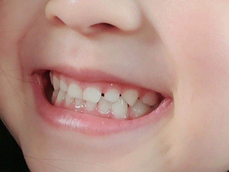 歯が並ぶスペースを確保できる