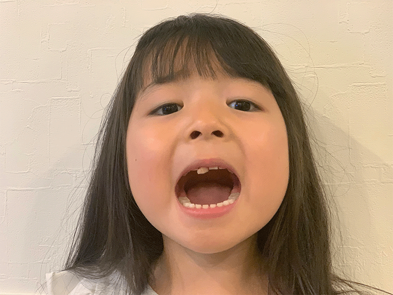 歯のでこぼこが大きい場合